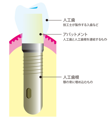 インプラント図解